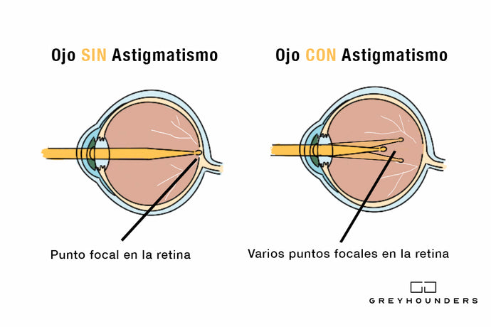 ¿Qué es el astigmatismo y cuál es su causa?