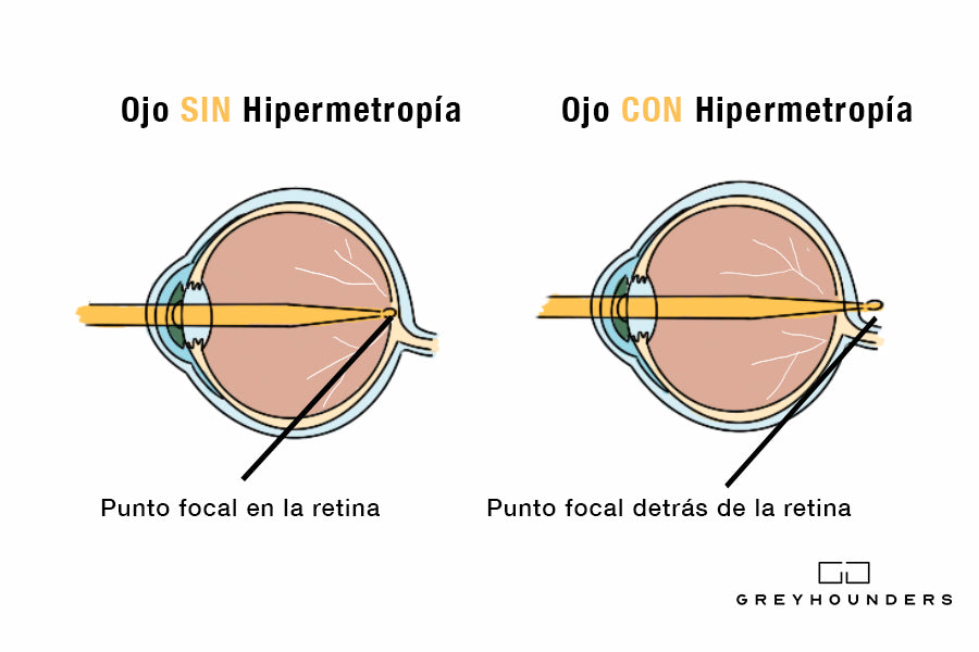 ¿Qué es la hipermetropía y a qué se debe?