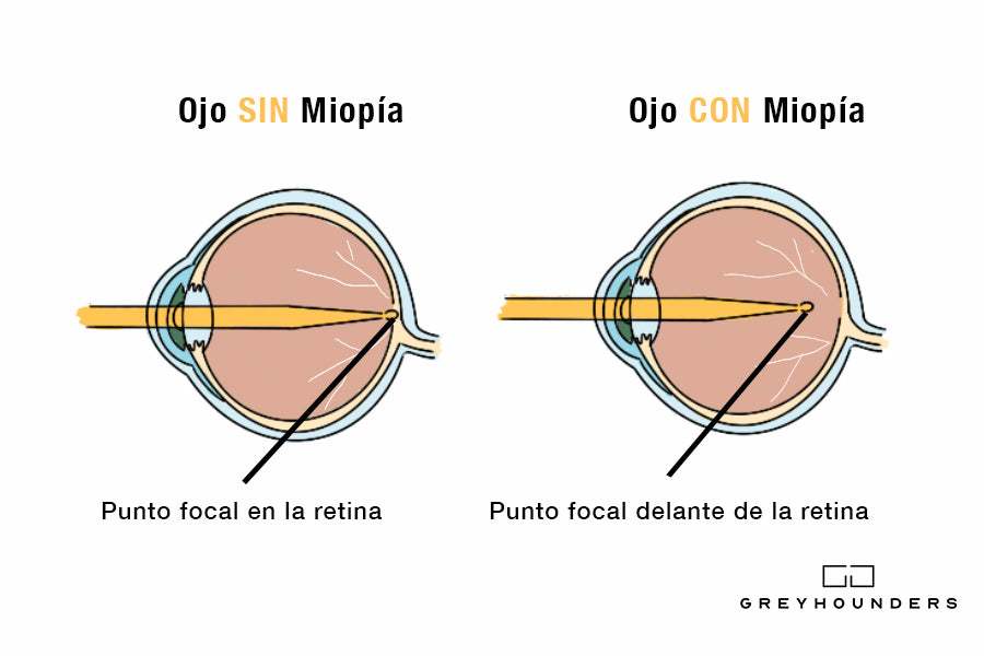 Miopía: Todo lo que necesitas saber
